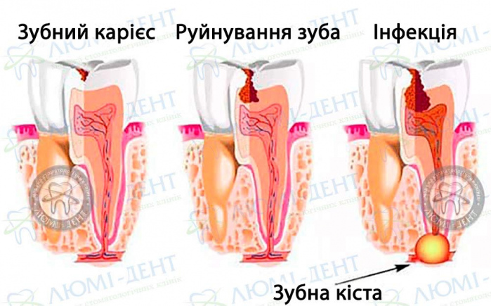 Резекція зуба фото ЛюміДент