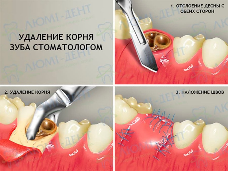 Этапы удаления корней зубов в Люми-Дент Удаление зубов фото Люми-Дент