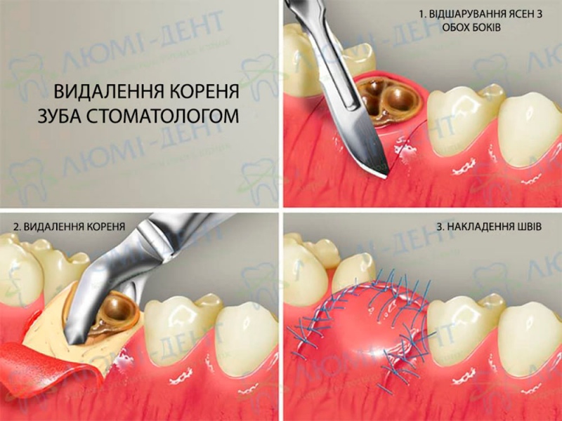 Видалення зубів фото Люмі-Дент