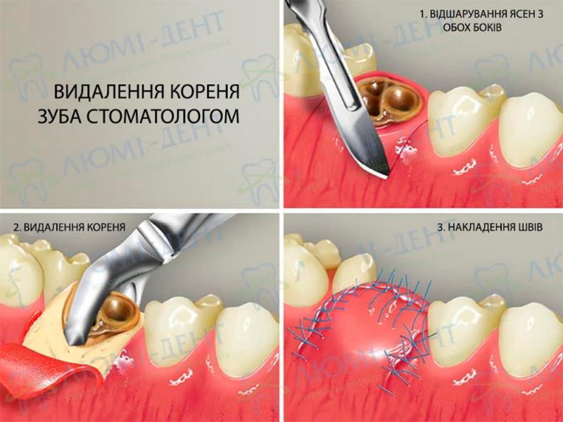 Етапи видалення коренів зубів в Люмі-Дент Видалення зубів фото Люмі-Дент