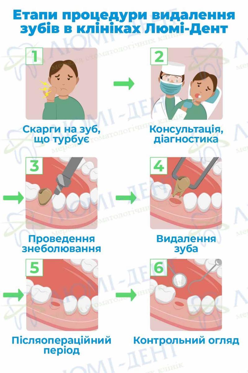 Етапи видалення зубів в Люмі-Дент Видалення зубів фото Люмі-Дент
