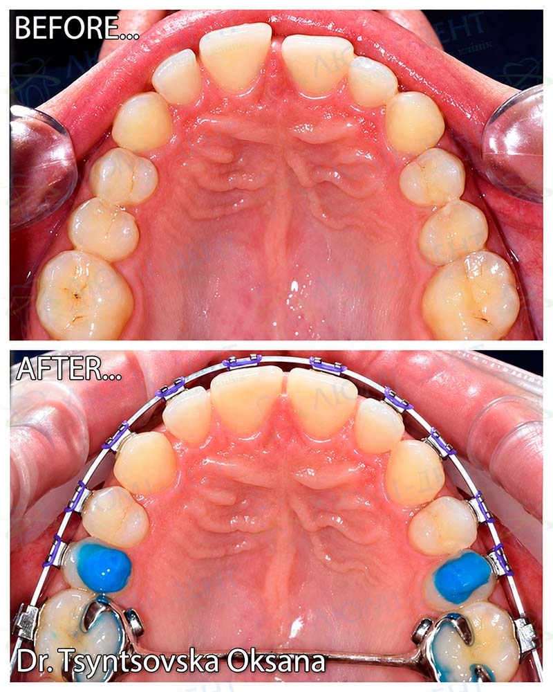 Результат работы исправления прикуса Виды брекетов фото Люми-Дент