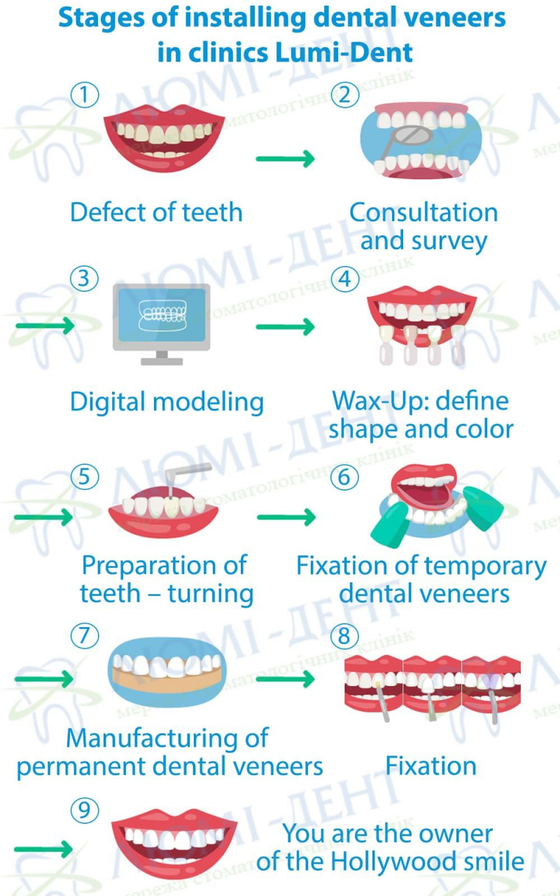 Teeth ceramic veneers Lumi-Dent