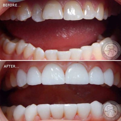 dental prosthesis