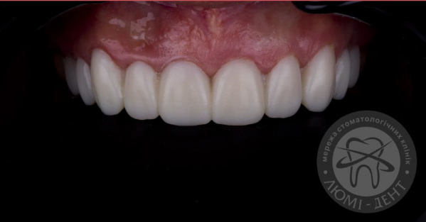 Накладки на зубы фото Люми-Дент