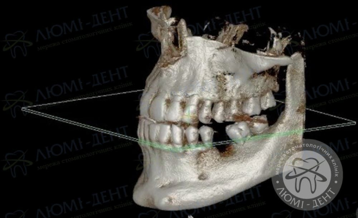 Як встановлюють зубні імплантати фото Люмі-Дент