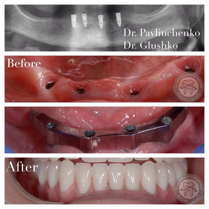 Як ставлять імплант зуба фото Люмі-Дент