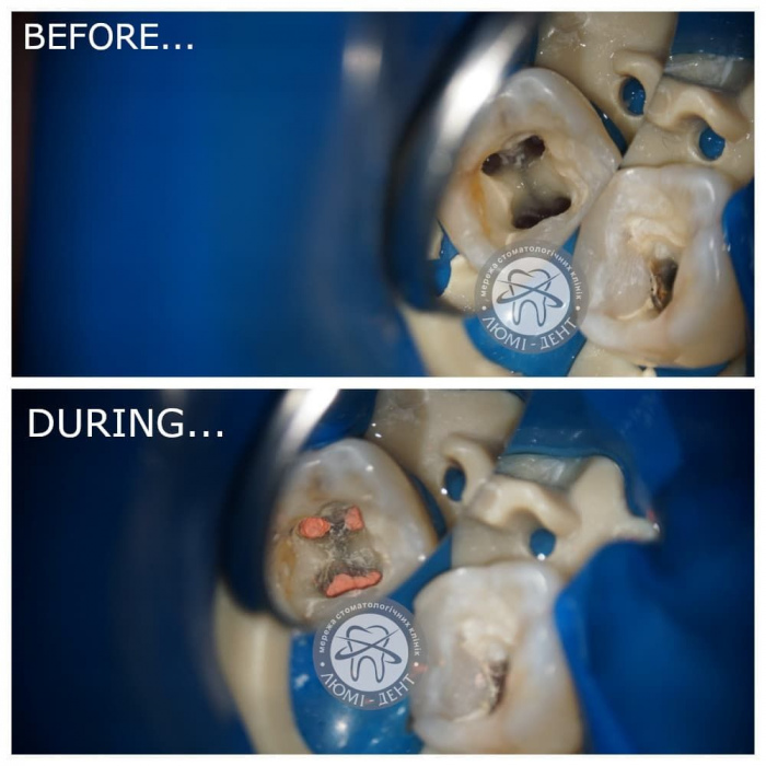 Чистка розпломбування каналів зуба фото київ Люмі-Дент