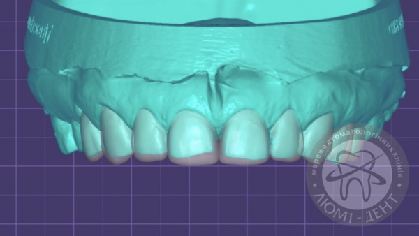 Зубні вініри фото Люмі-Дент