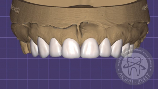 Как ставят виниры фото киев Люми-Дент