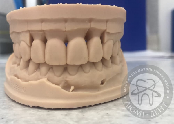 Ceramic veneers of teeth photo Lumi-Dent