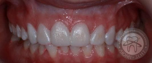 Красивые и белые зубы фото киев Люми-Дент