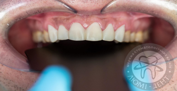 plates on teeth photo Lumi-Dent