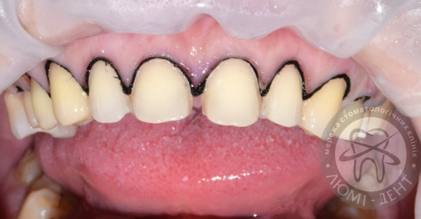 Veneers for teeth Lumi-Dent