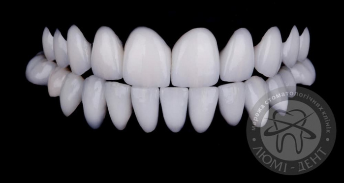 Onlays on teeth veneers on teeth photo Kiev Lumi-Dent