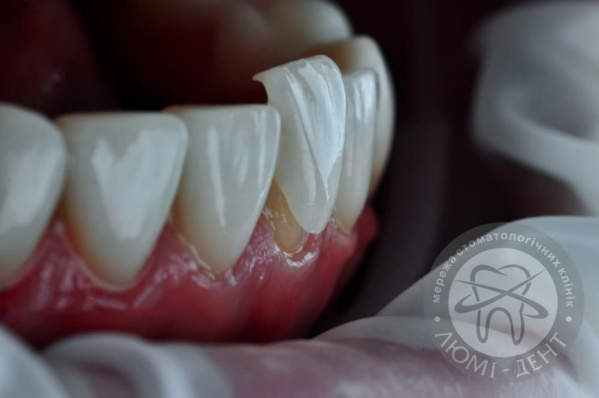 Onlays on teeth to install veneers on teeth photo Kiev Lumi-Dent