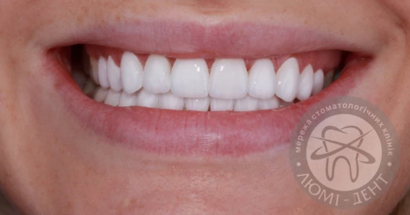 Виниры на зубах фото Люми-Дент