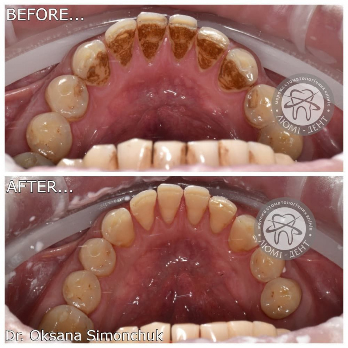 Чистка зубів Air Flow фото до і після Люмі-Дент