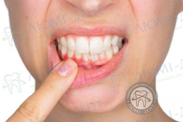 Зуб хитається і болить фото лікування Люмі-Дент