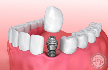 Що таке Імплантація зубів?