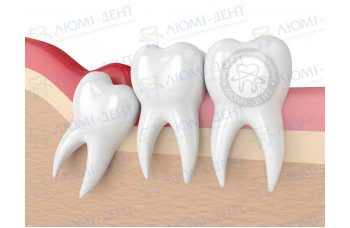 капюшон зуба мудрості фото ЛюміДент