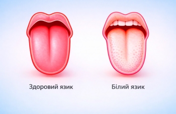 Молочниця в роті фото ЛюміДент