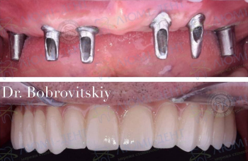 Види зубних протезів фото ЛюміДент