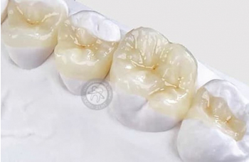Методи відновлення зубів