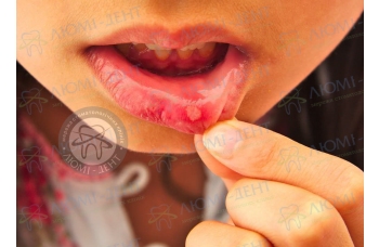 Стоматит у роті у дорослих лікування Київ фото Люмі-Дент