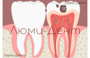 Пульпит лечение методы симптомы - стоматология ЛюмиДент