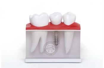 імплантація зубів фото люмідент