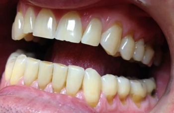 Клиновидний дефект зубів лікування Київ фото Люмі-Дент