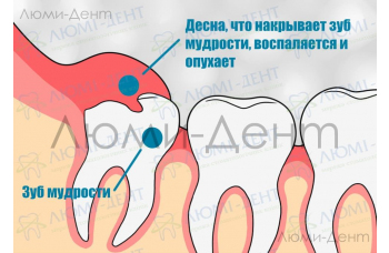 Зубы мудрости - лечить или удалить?