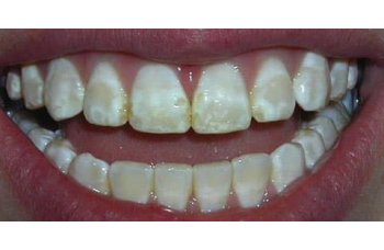 Гиперплазия эмали зубов