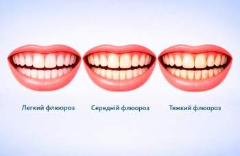 Флюороз зубів фото Люмі-Дент