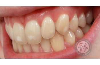 Гіперплазія емалі зубів фото ЛюміДент