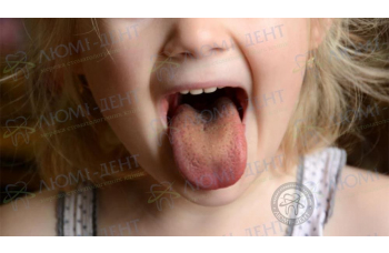 Коричневий наліт на язиці фото ЛюміДент
