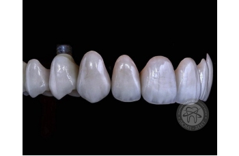 Что такое Протезирование зубов?