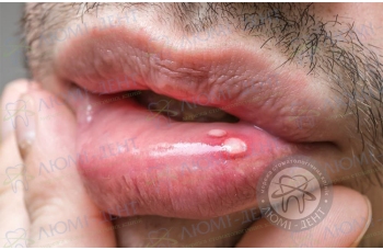 Виразки у роті: види, причини лікування київ Люмі-Дент