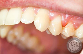 Гранулема зуба лікування ЛюміДент| Що таке гранулема симптоми причини