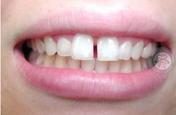 Щілина між зубами діастема методи лікування Київ ЛюміДент