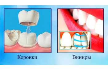 Вініри або коронки фото ЛюміДент Вініри або коронки фото ЛюміДент