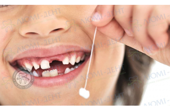 Удаление зубов в домашних условиях
