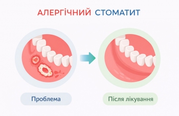 Аллергический стоматит