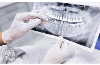 Панорамний знімок зубів