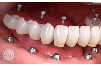 Незнімні зубні протези