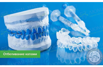 Відбілювання зубів капами - ціна в Києві