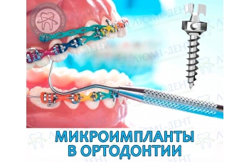 Мікроімпланти в ортодонтії