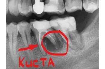 кіста зуба на яснах фото Люмі-Дент