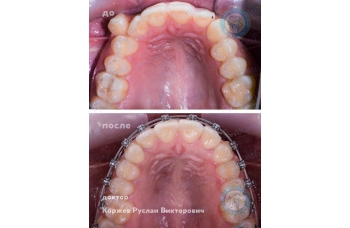 как ставят брекеты фото ЛюмиДент